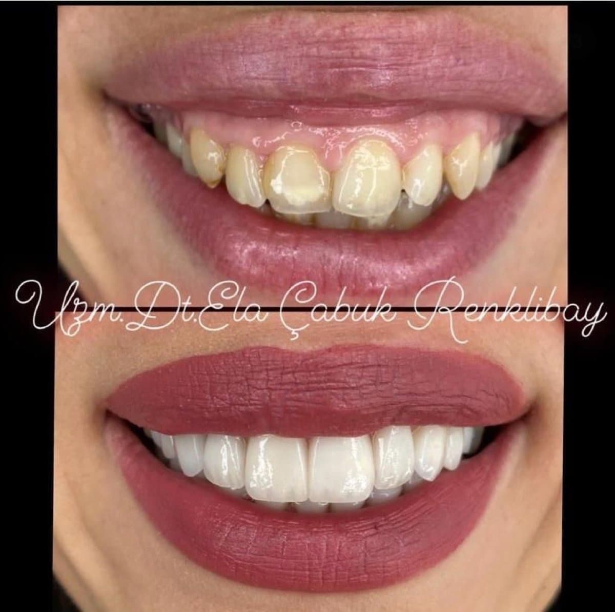 gingivectomy