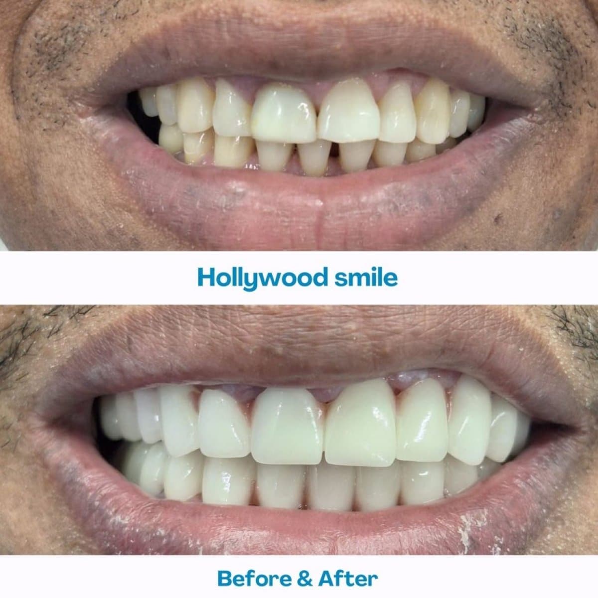 Hollywood Smile