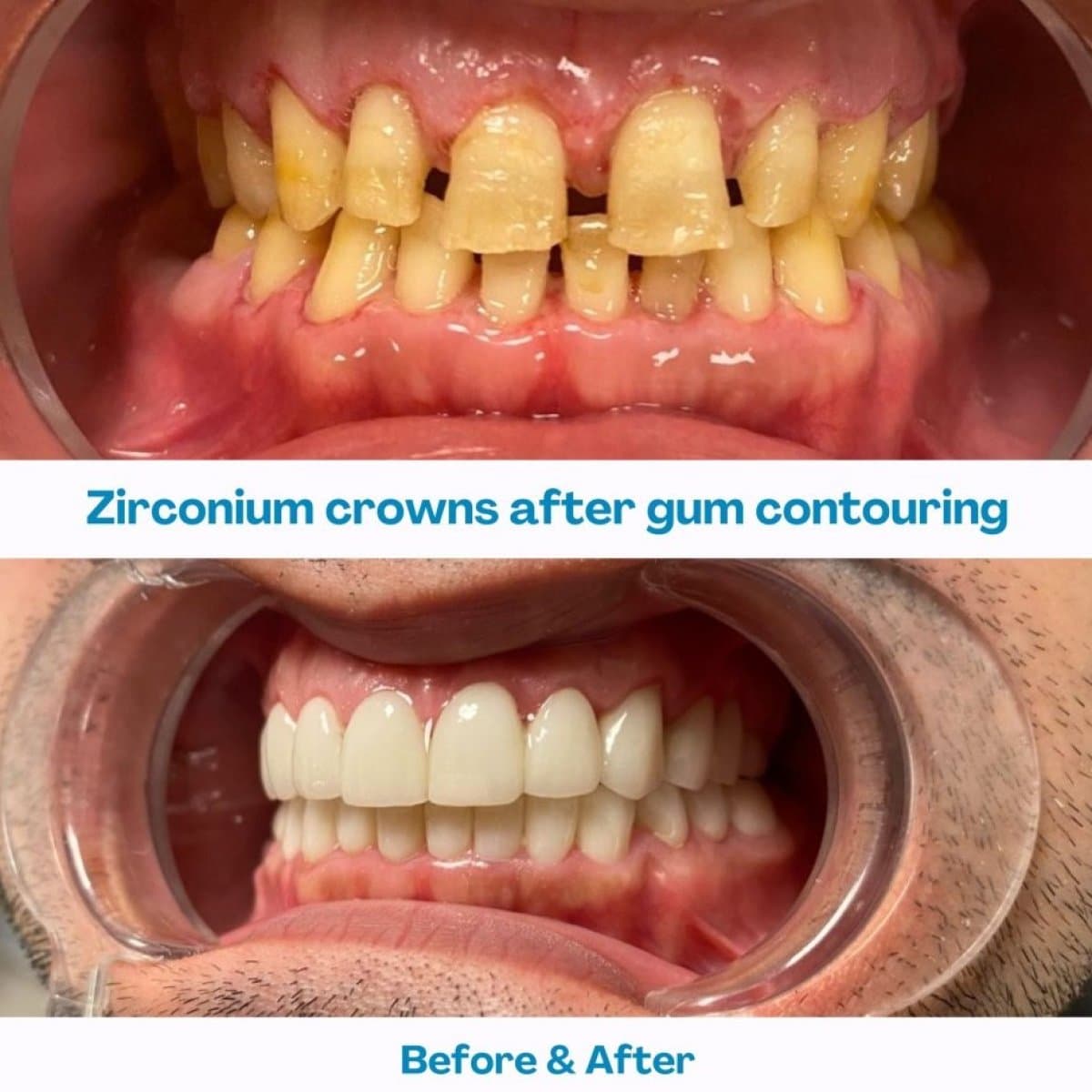 zirconia crown installation and gum contouring