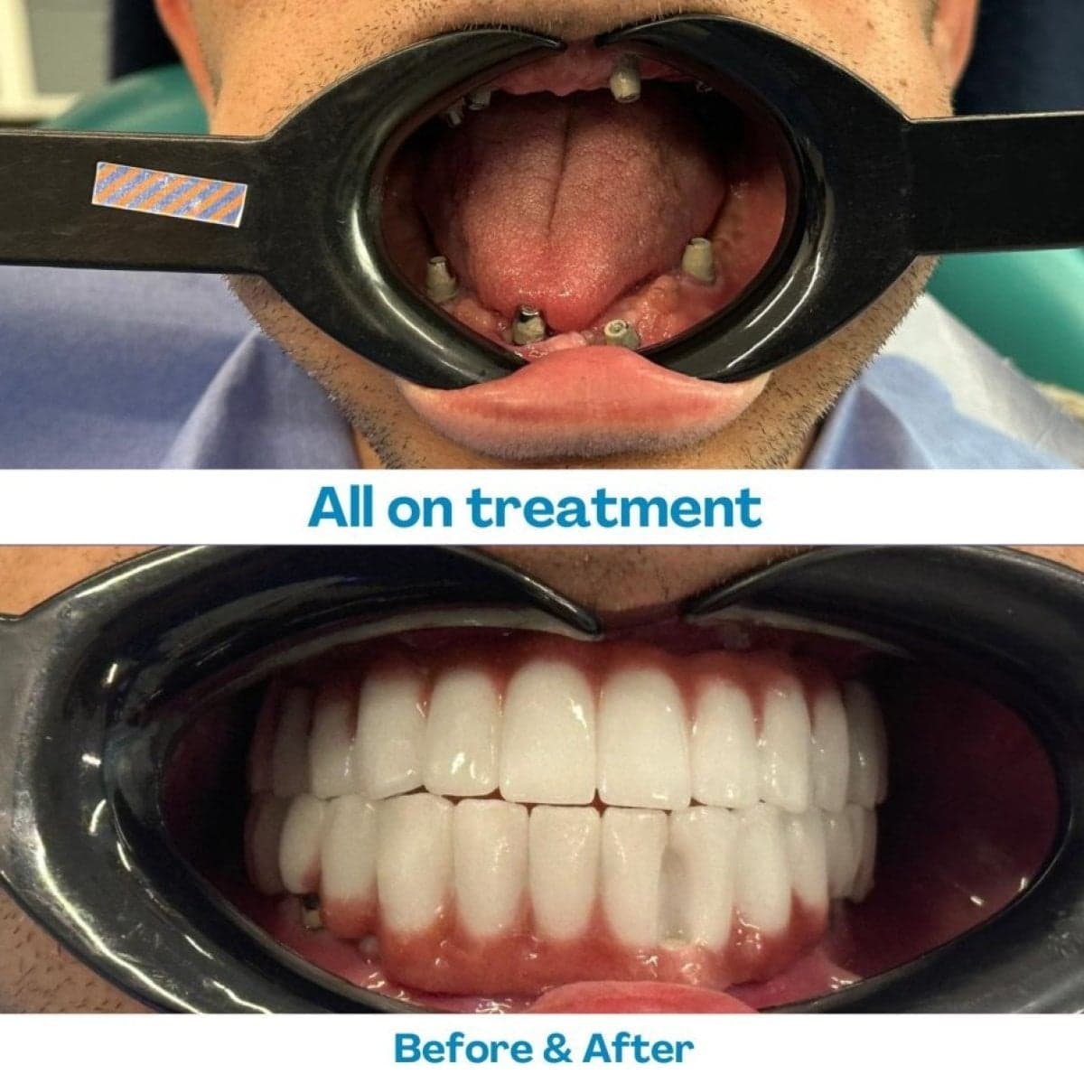 Zygomatic All-on-4 dental implants