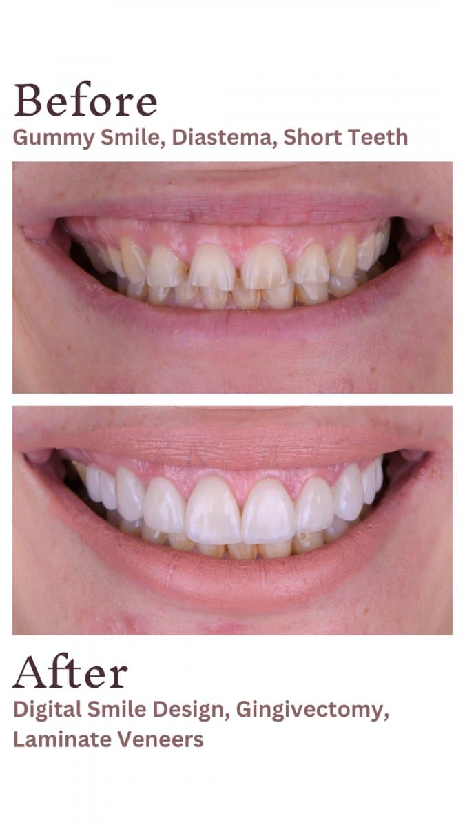 at UltimaDent Clinic – veneers and gingivectomy