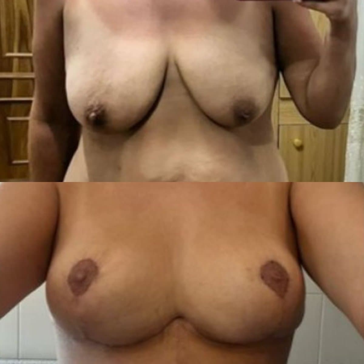 breast implants with lift