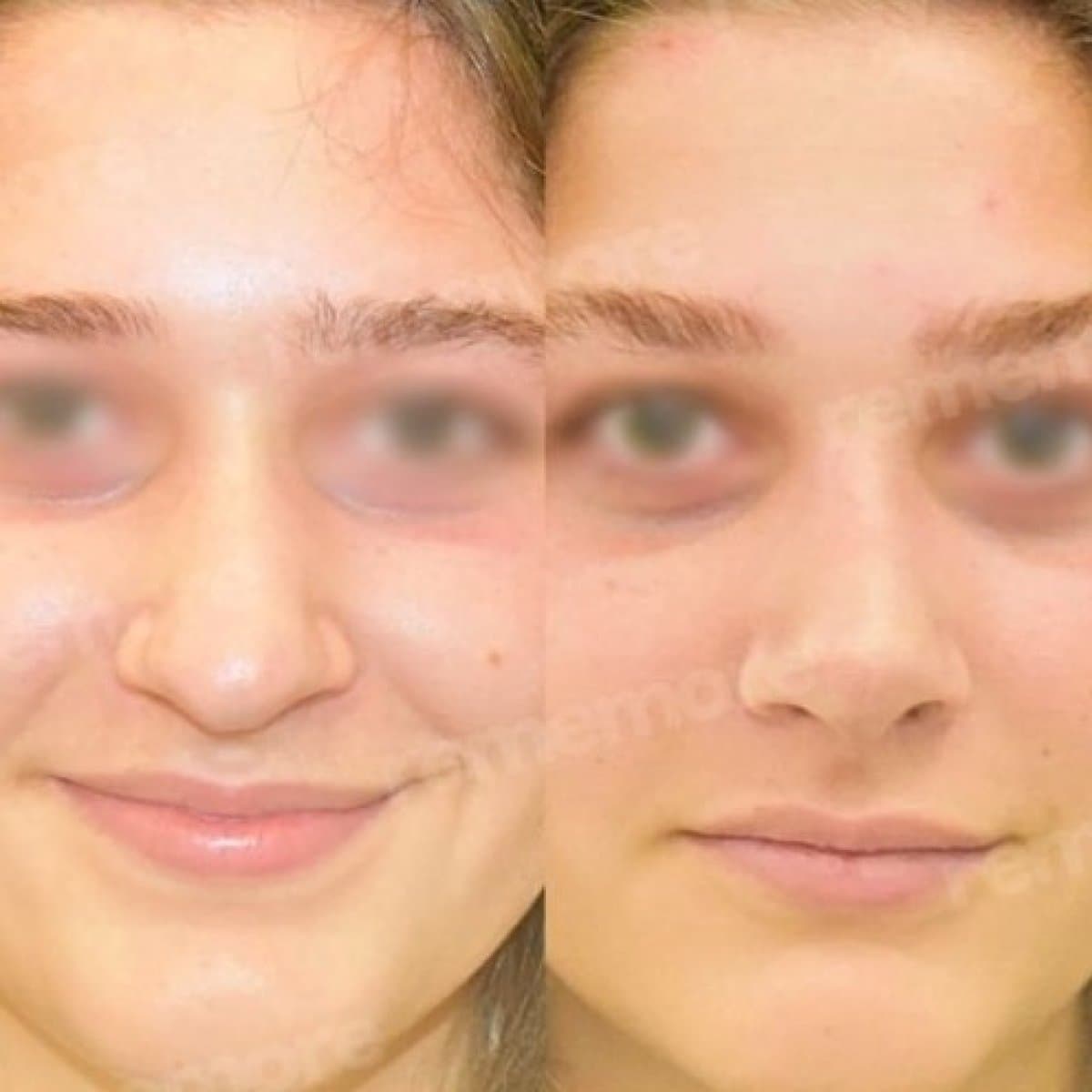 rhinoplasty