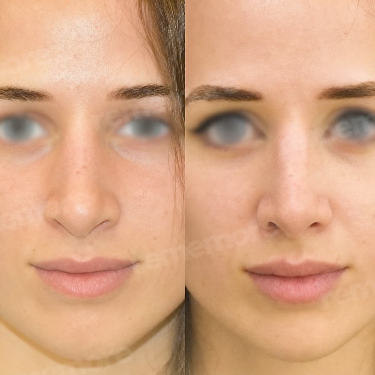 rhinoplasty
