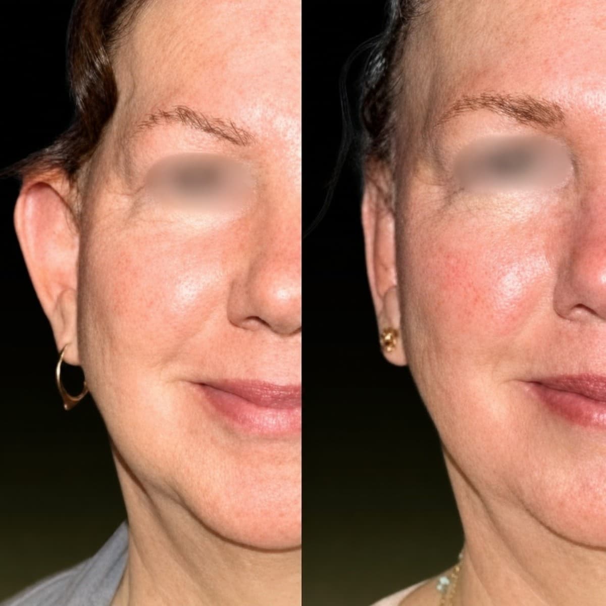otoplasty