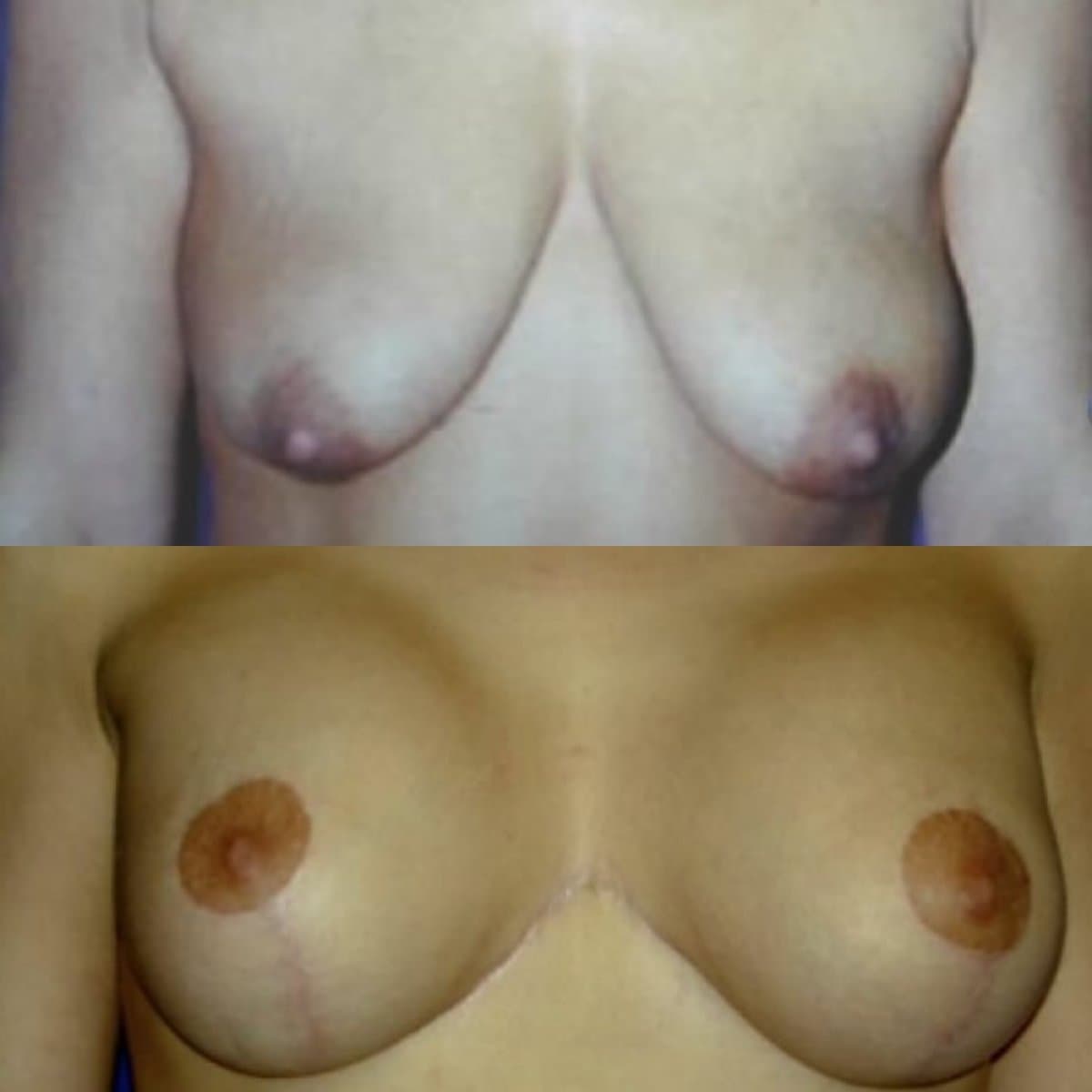 breast implants with lift