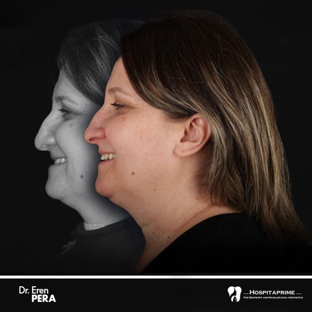 orthognathic surgery