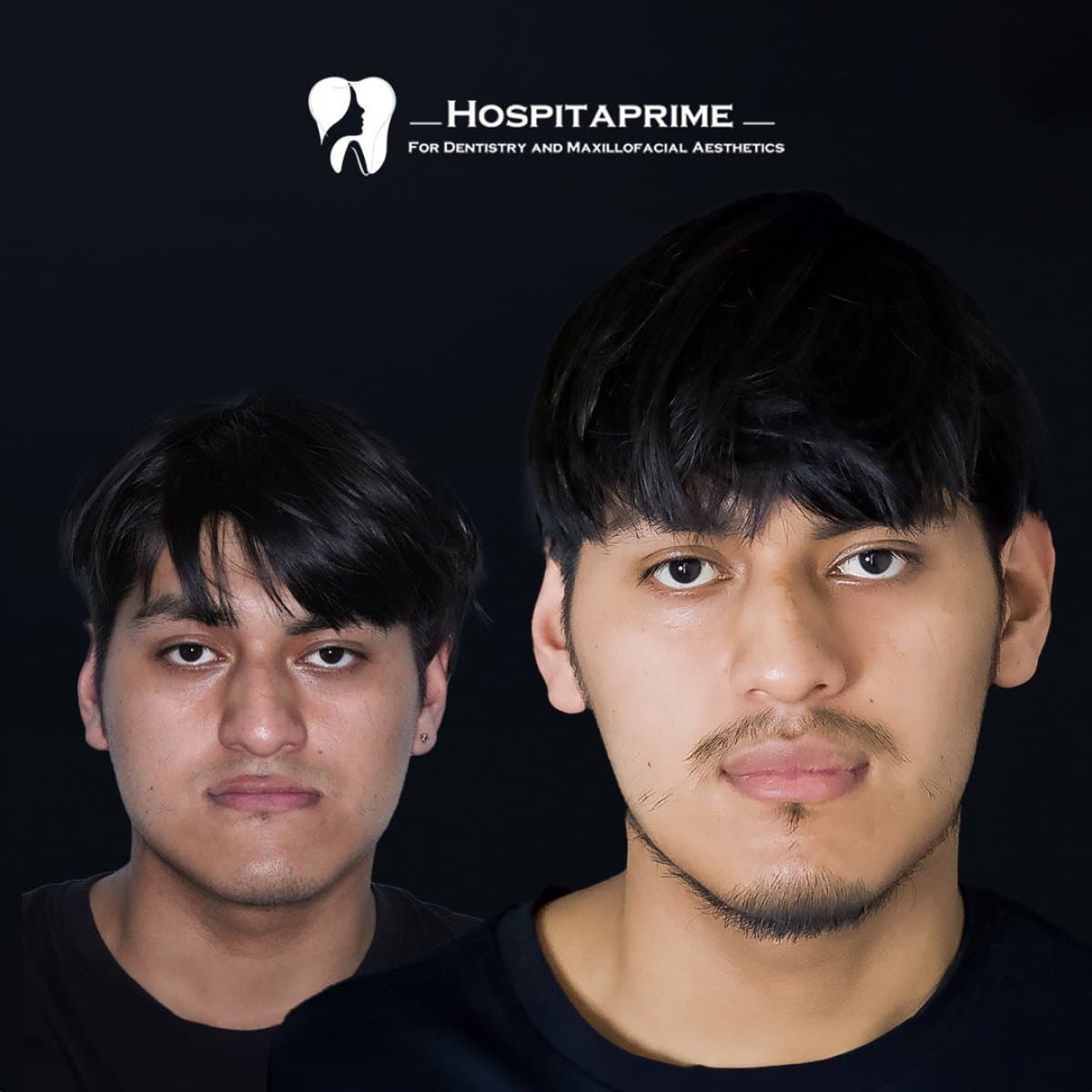 orthognathic surgery