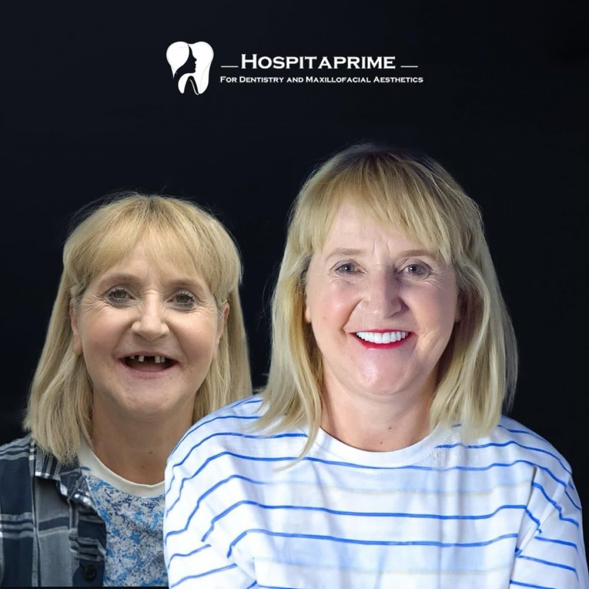 All-on-4 dental implants