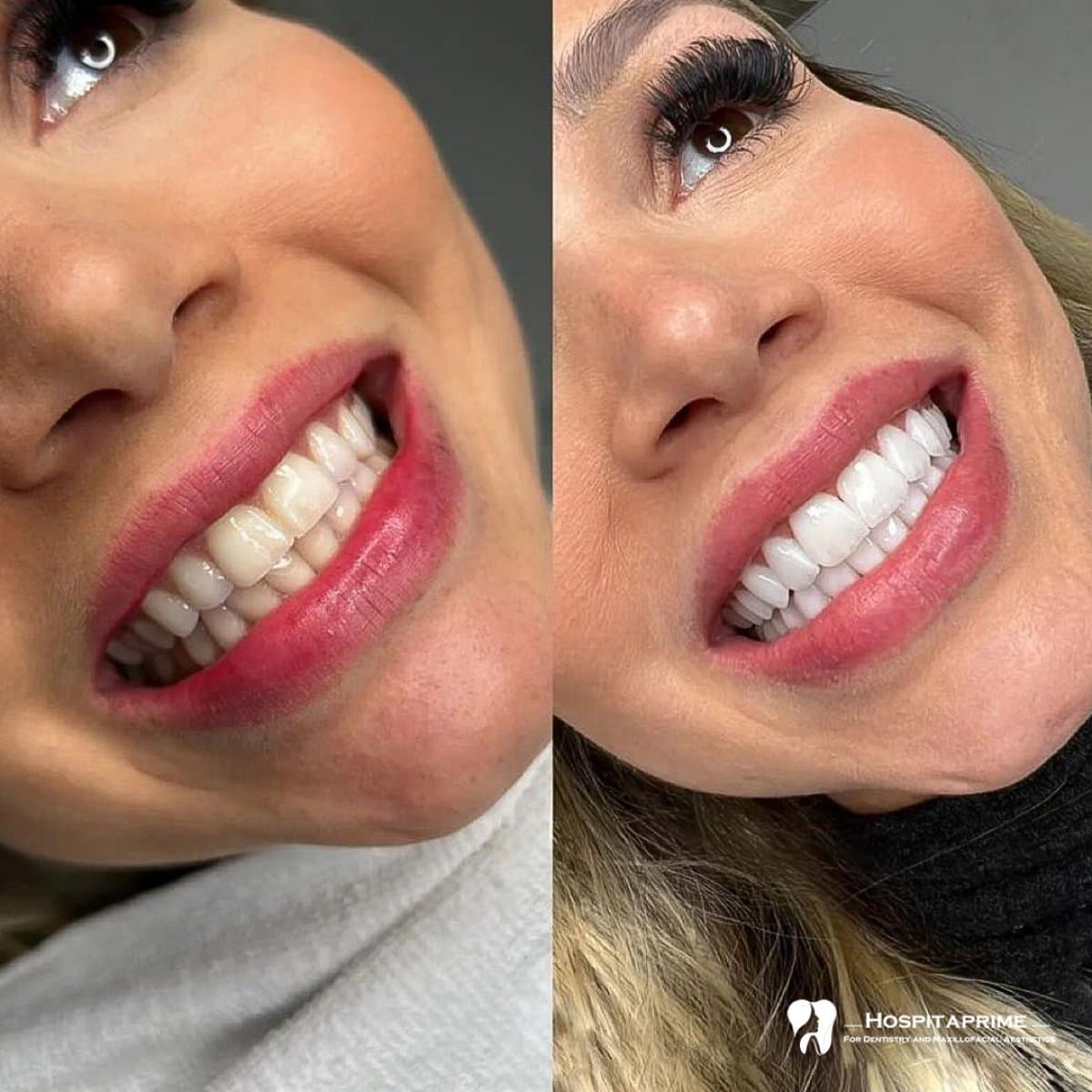 zirconia veneers