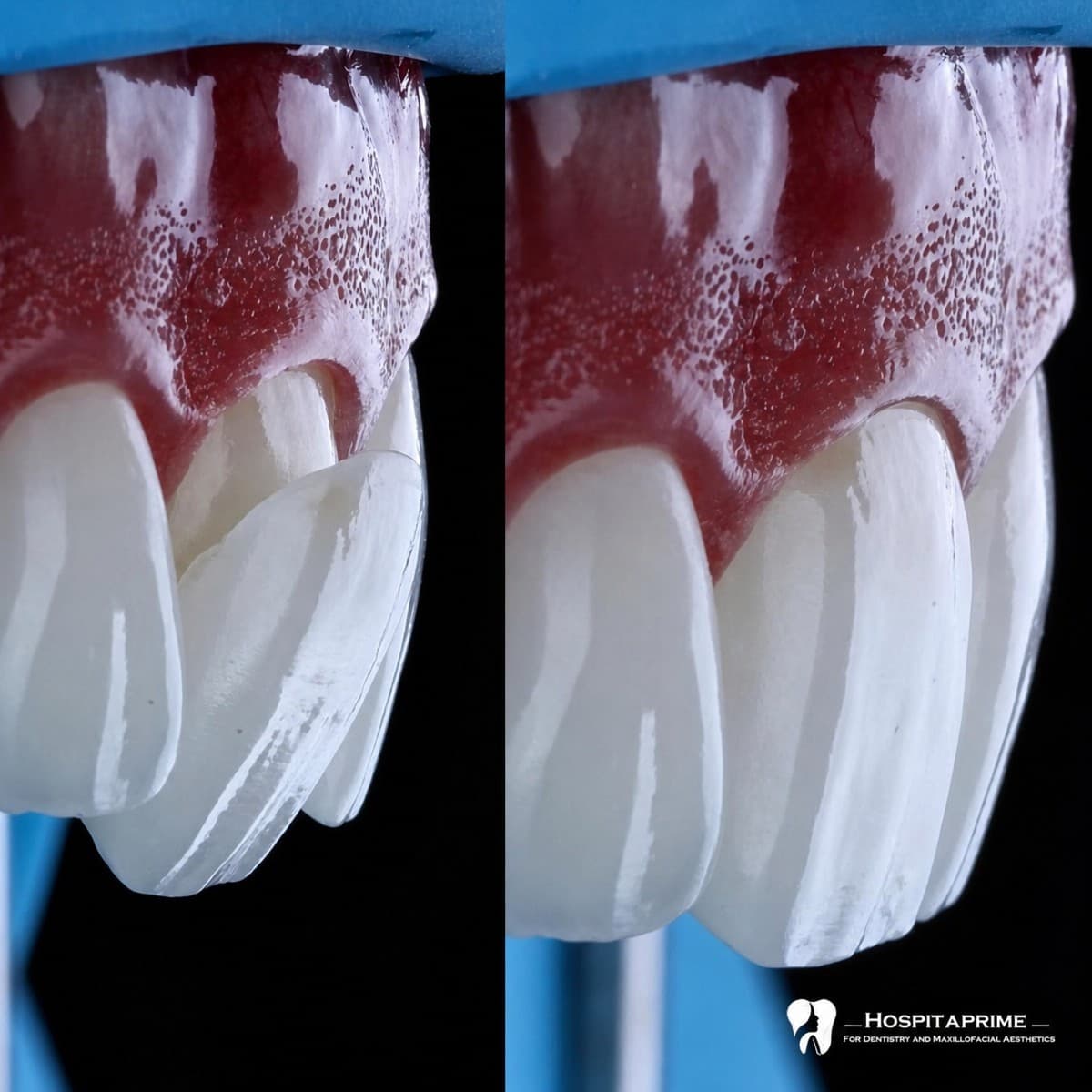 veneers