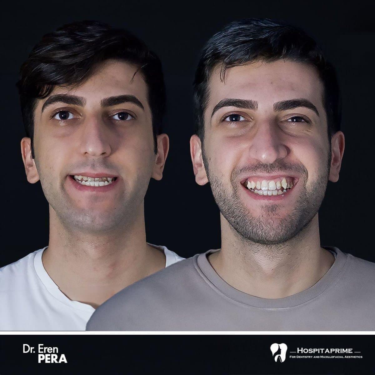 orthognathic surgery