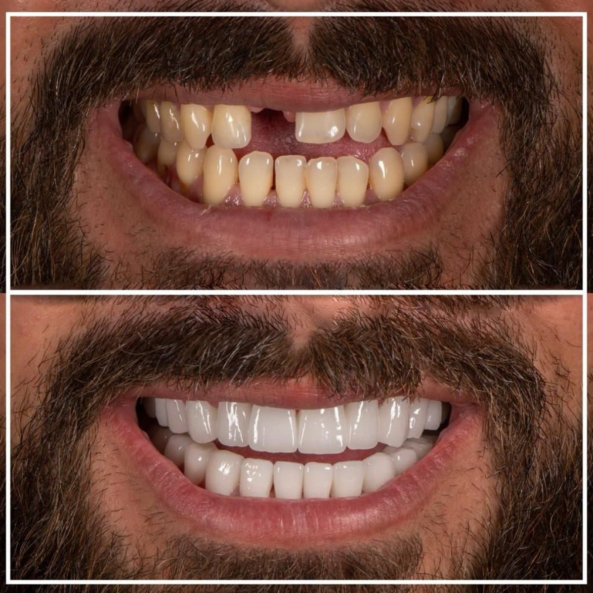 tooth extraction