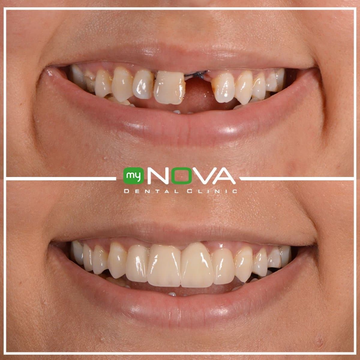 tooth extraction