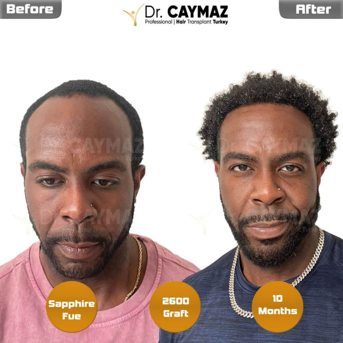 Sapphire FUE hair transplant