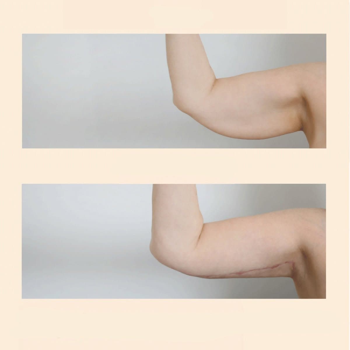 arm lift (brachioplasty)