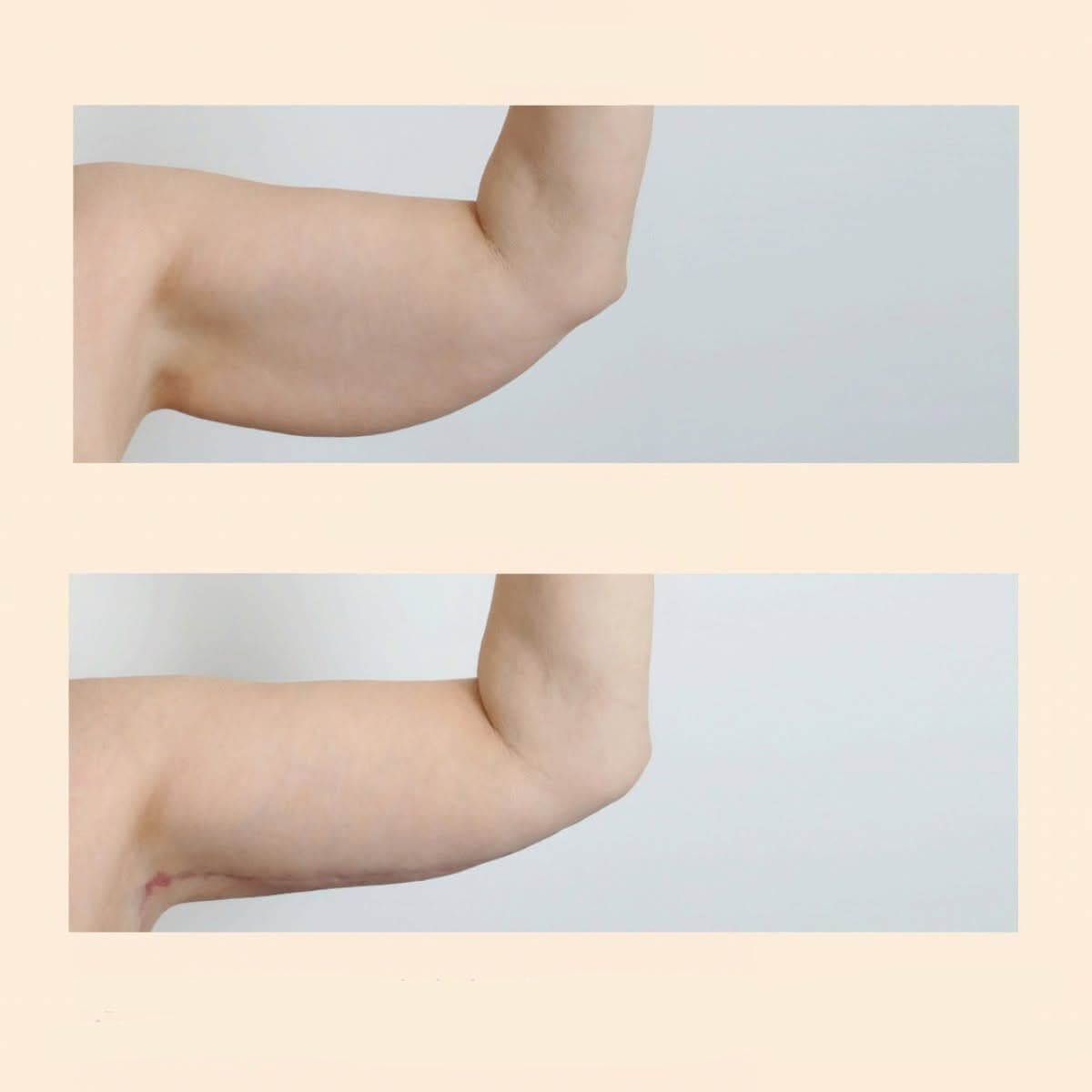 arm lift (brachioplasty)