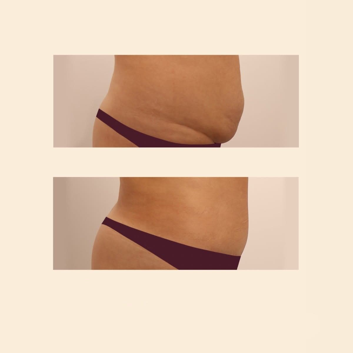 tummy tuck and liposuction