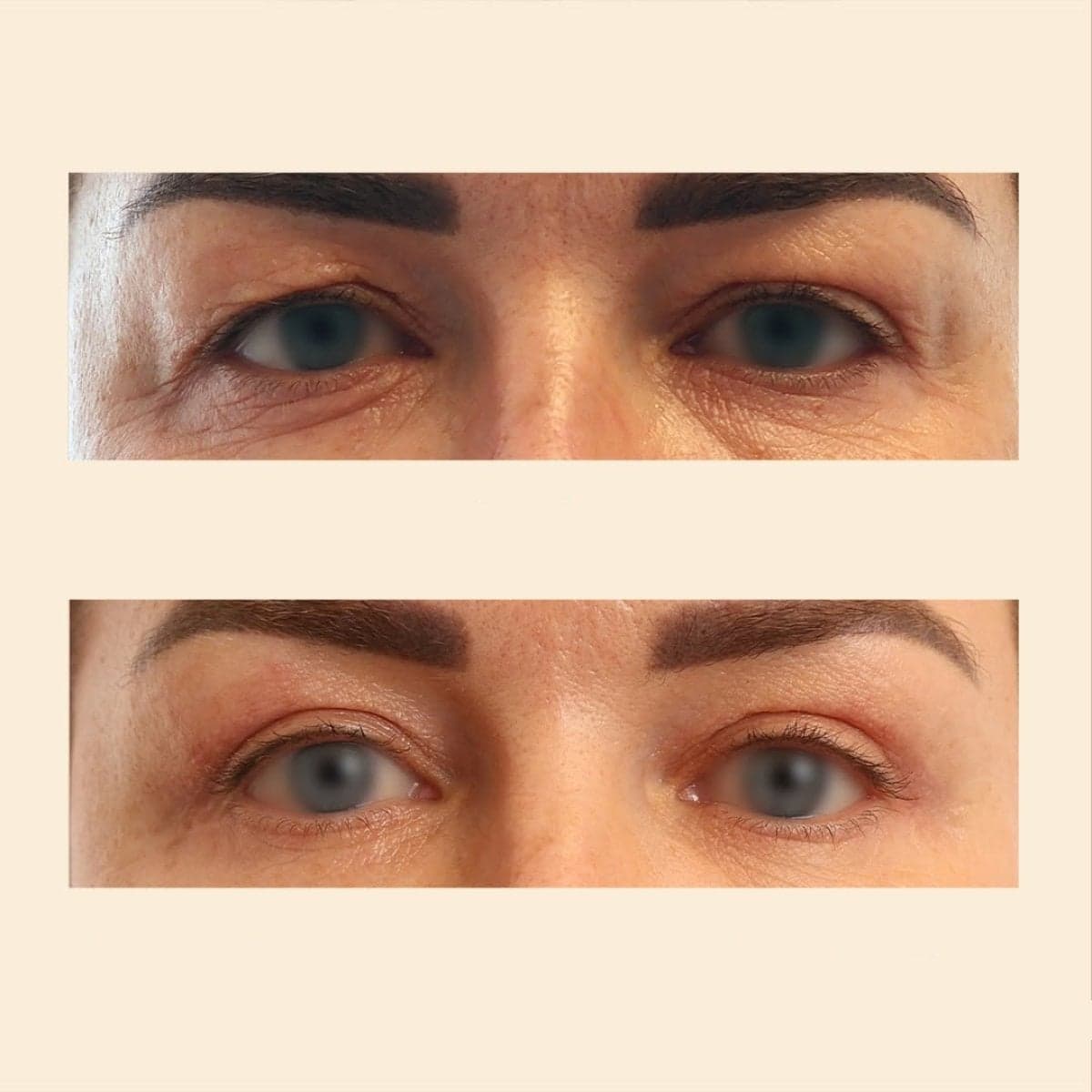 blepharoplasty