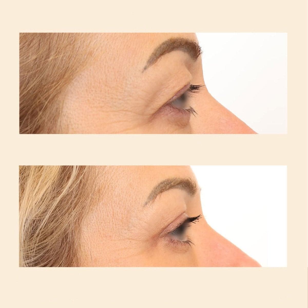 blepharoplasty