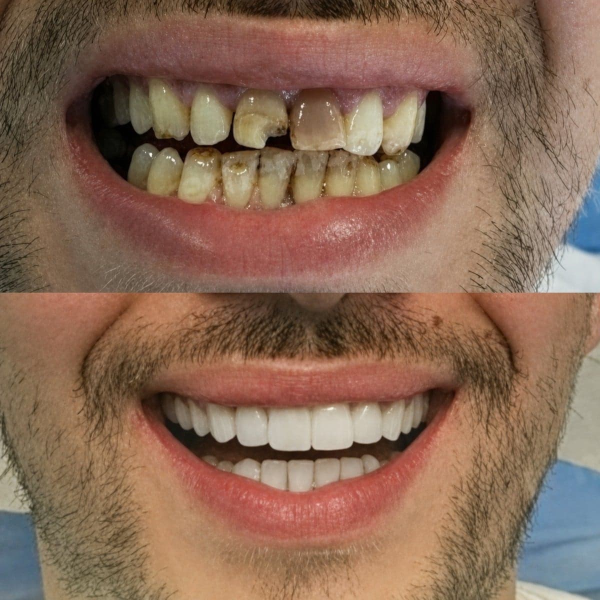root canal treatment