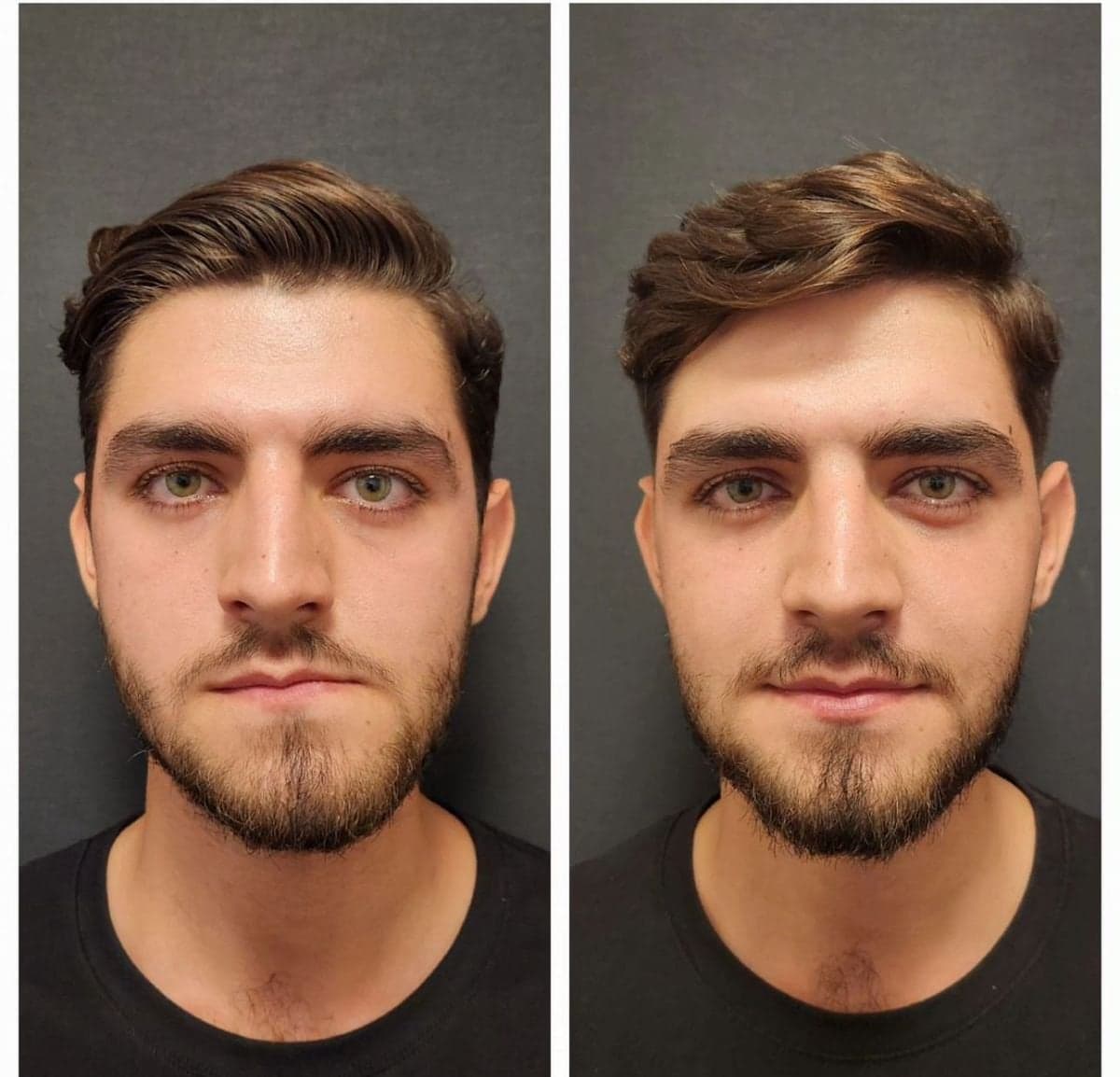 cheekbone reduction