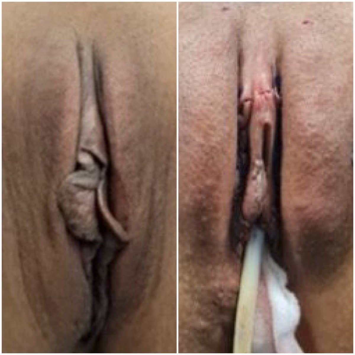 labiaplasty