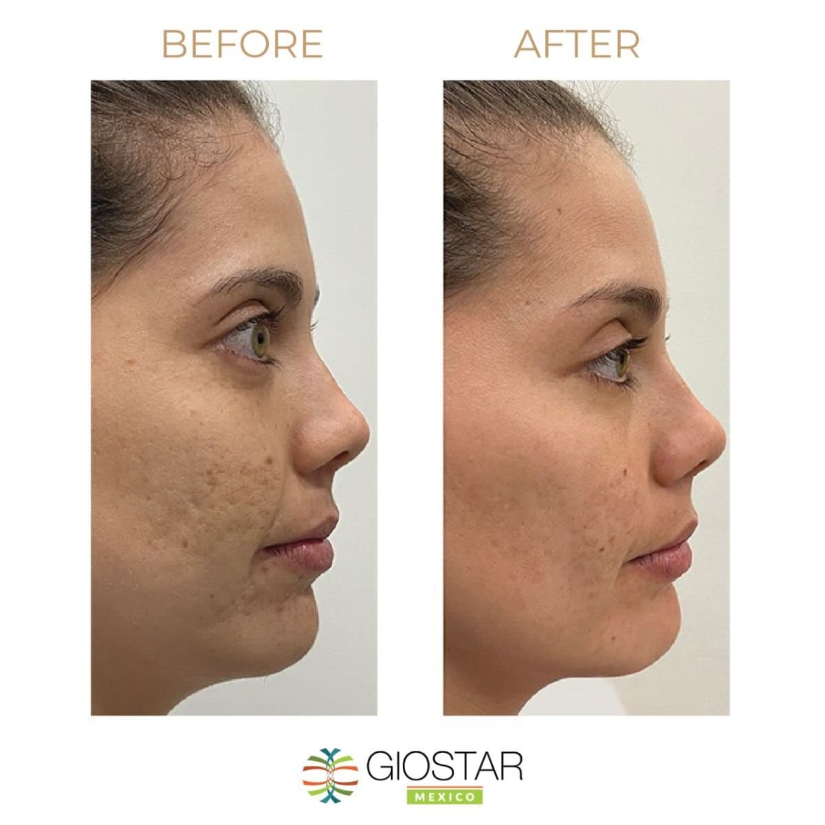 stem cell therapy for facial skin rejuvenation