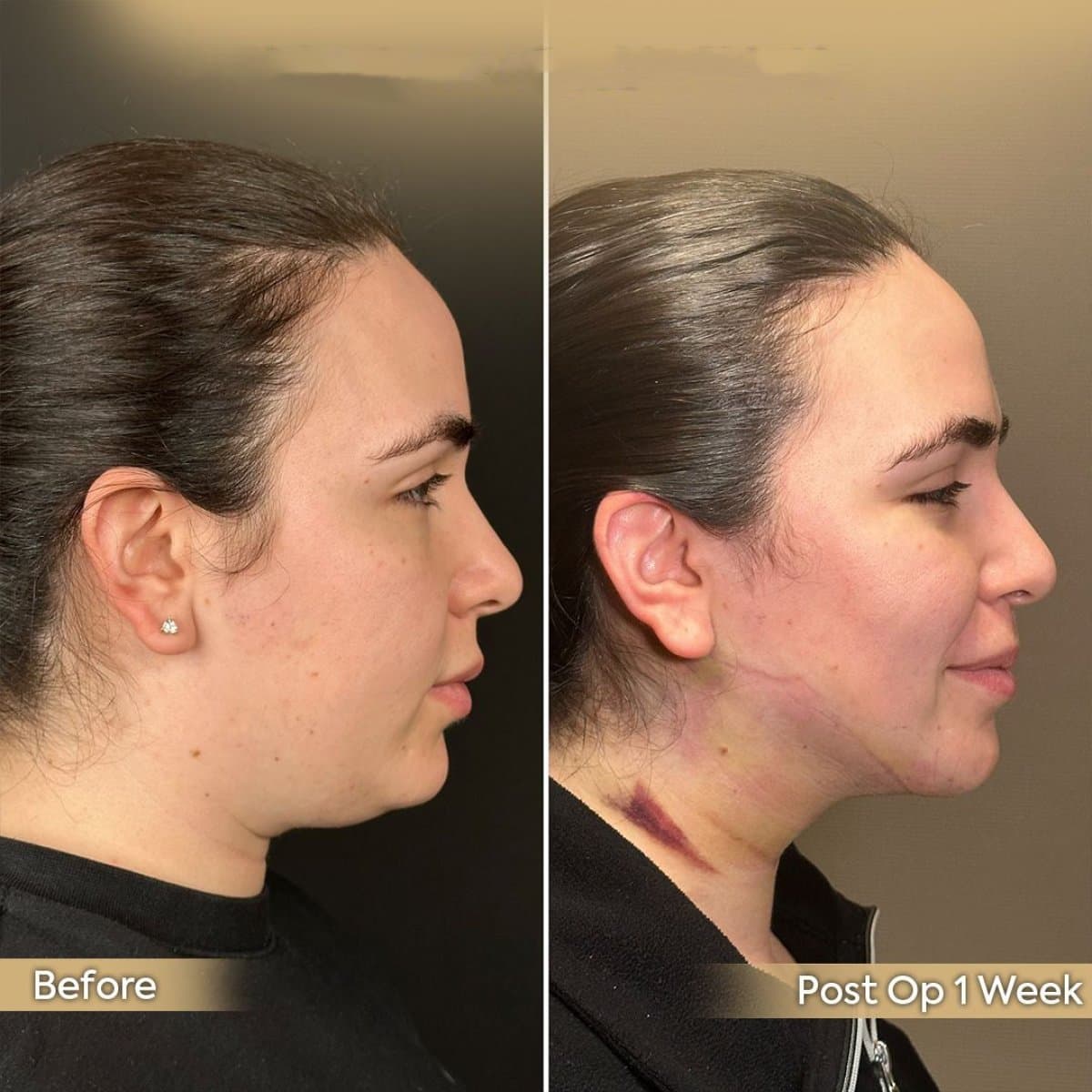 buccal fat extraction