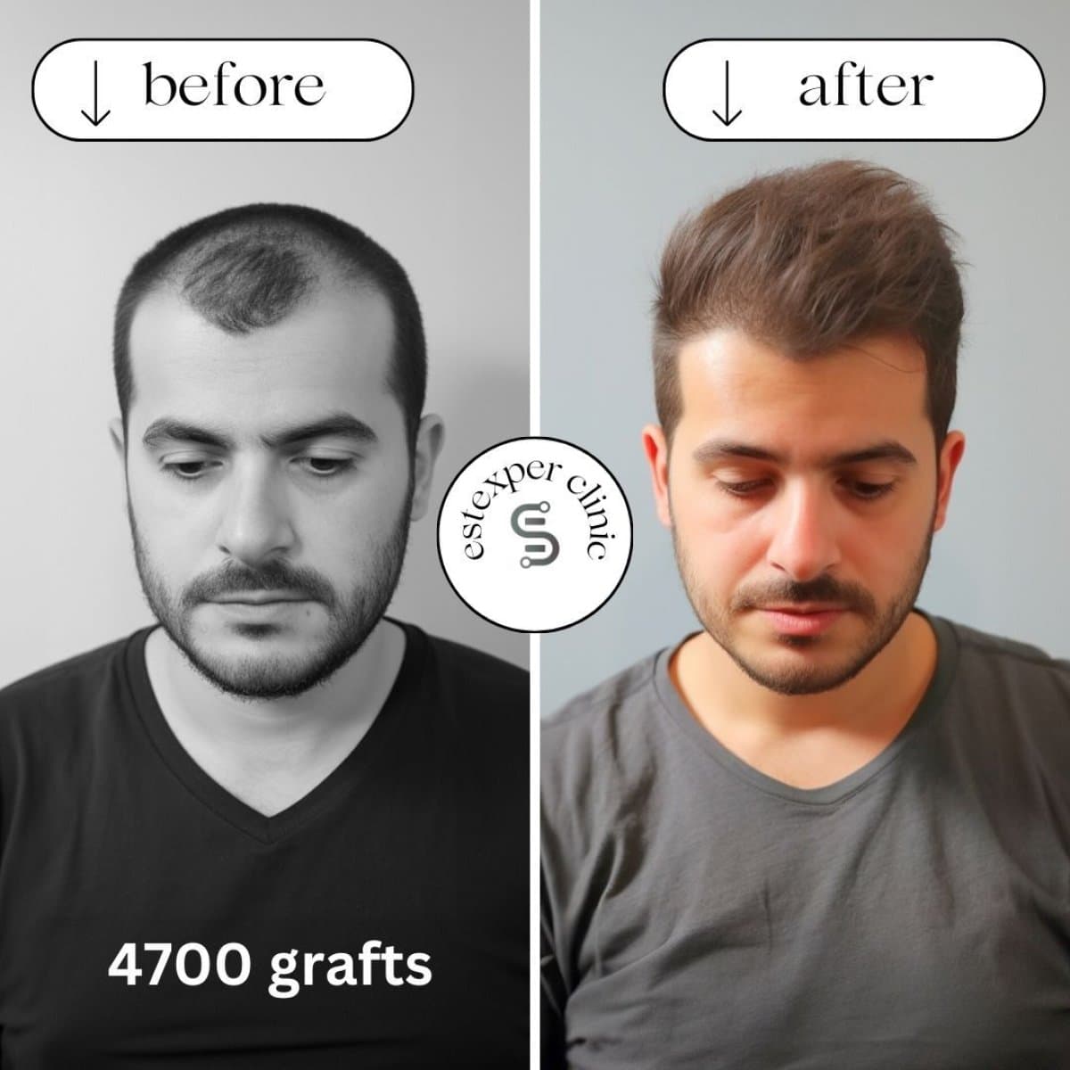 hair transplant