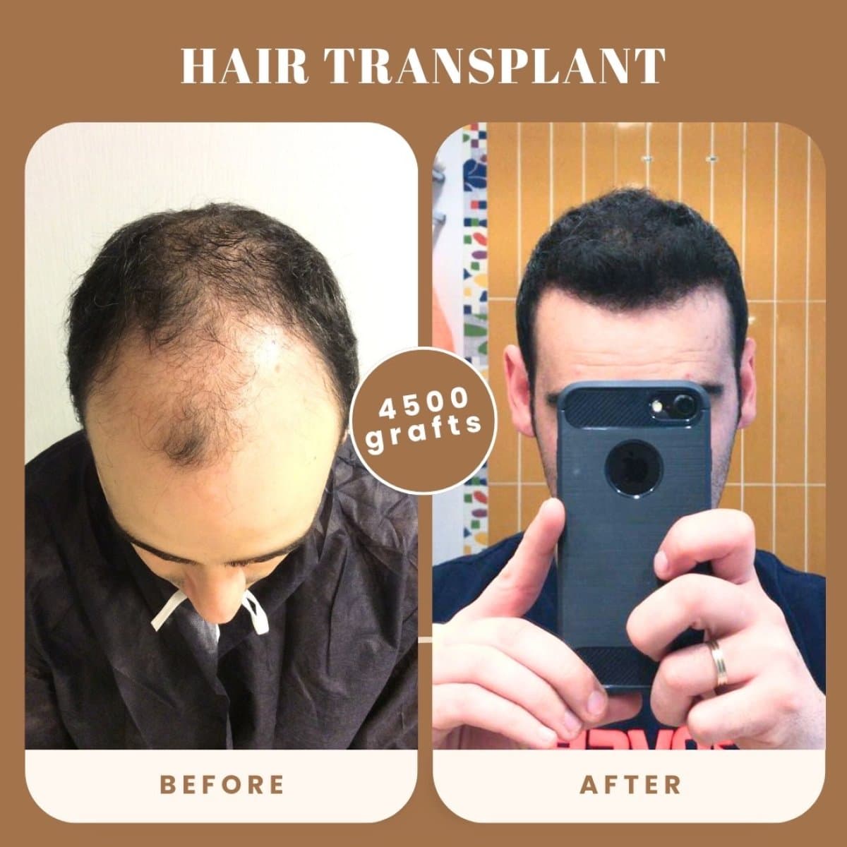 hair transplant