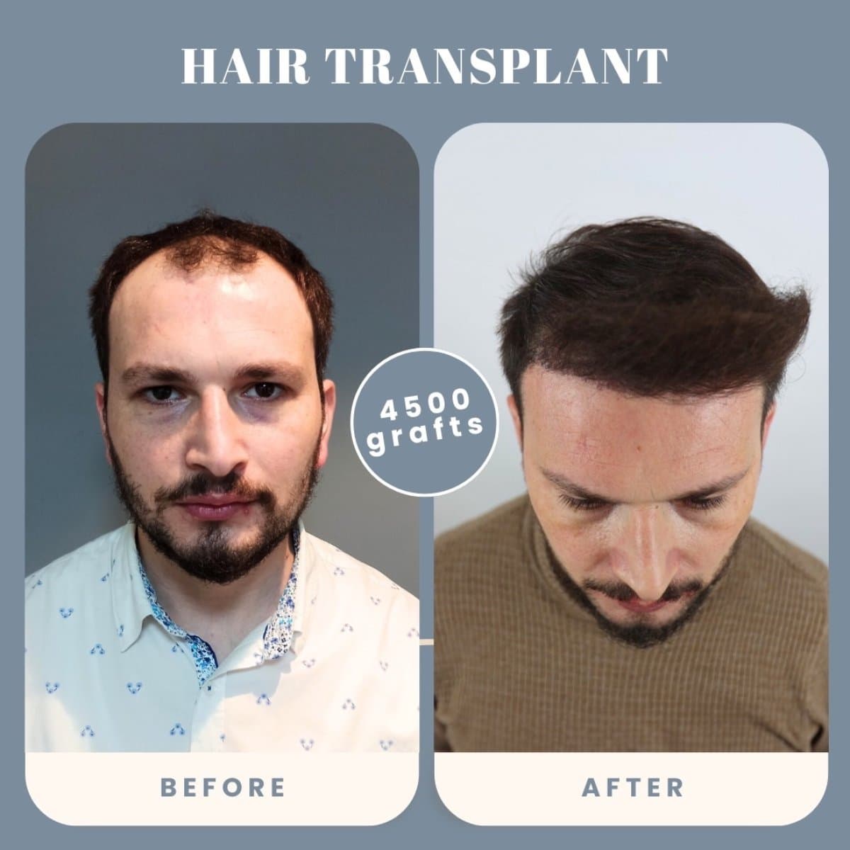 hair transplant