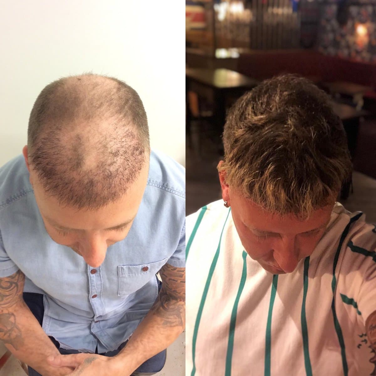 hair transplant