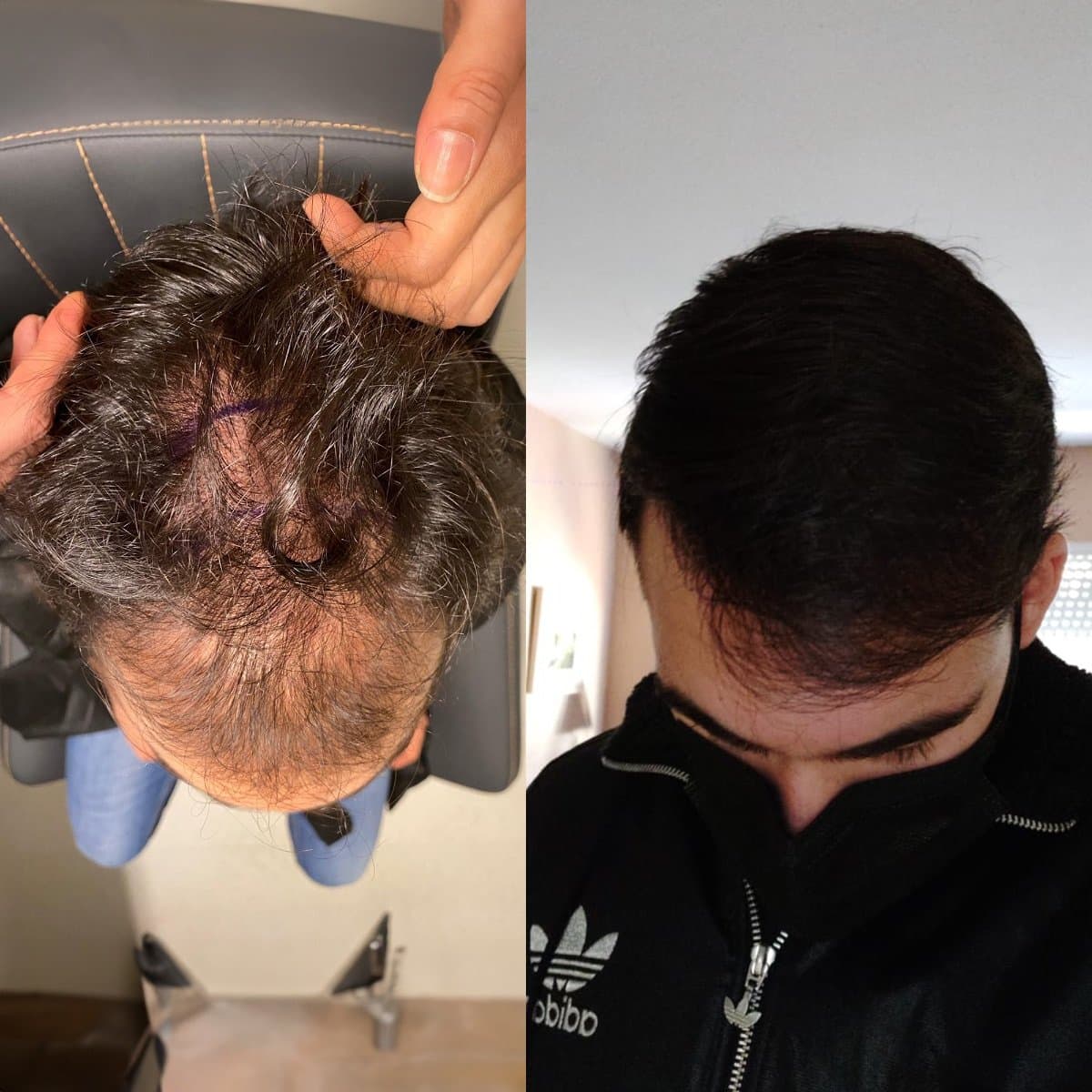 hair transplant