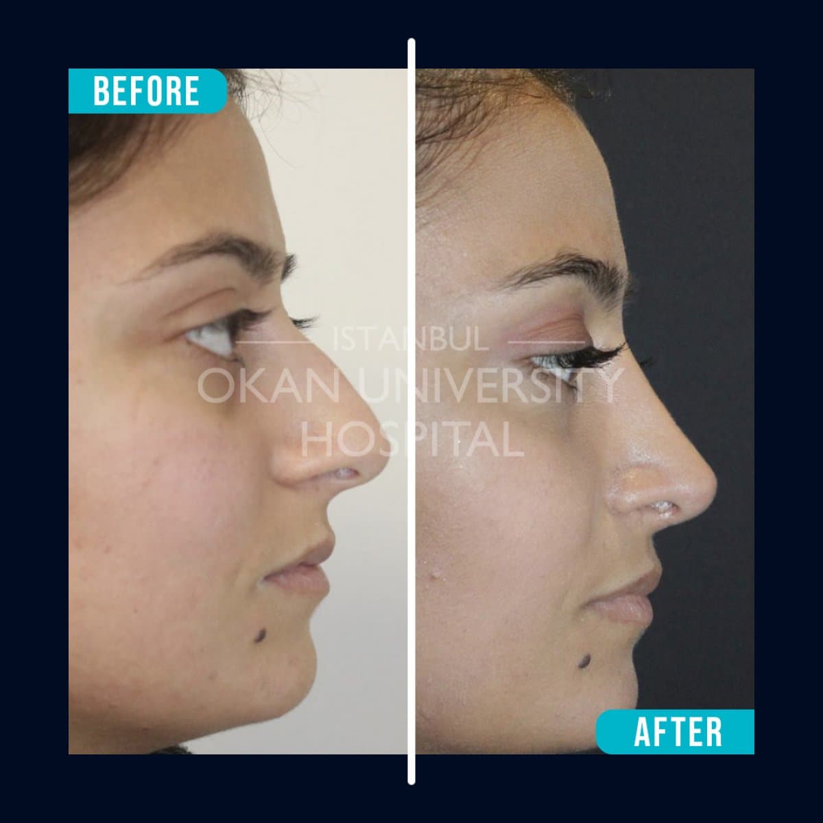 rhinoplasty