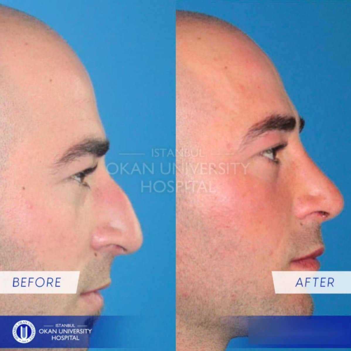 rhinoplasty