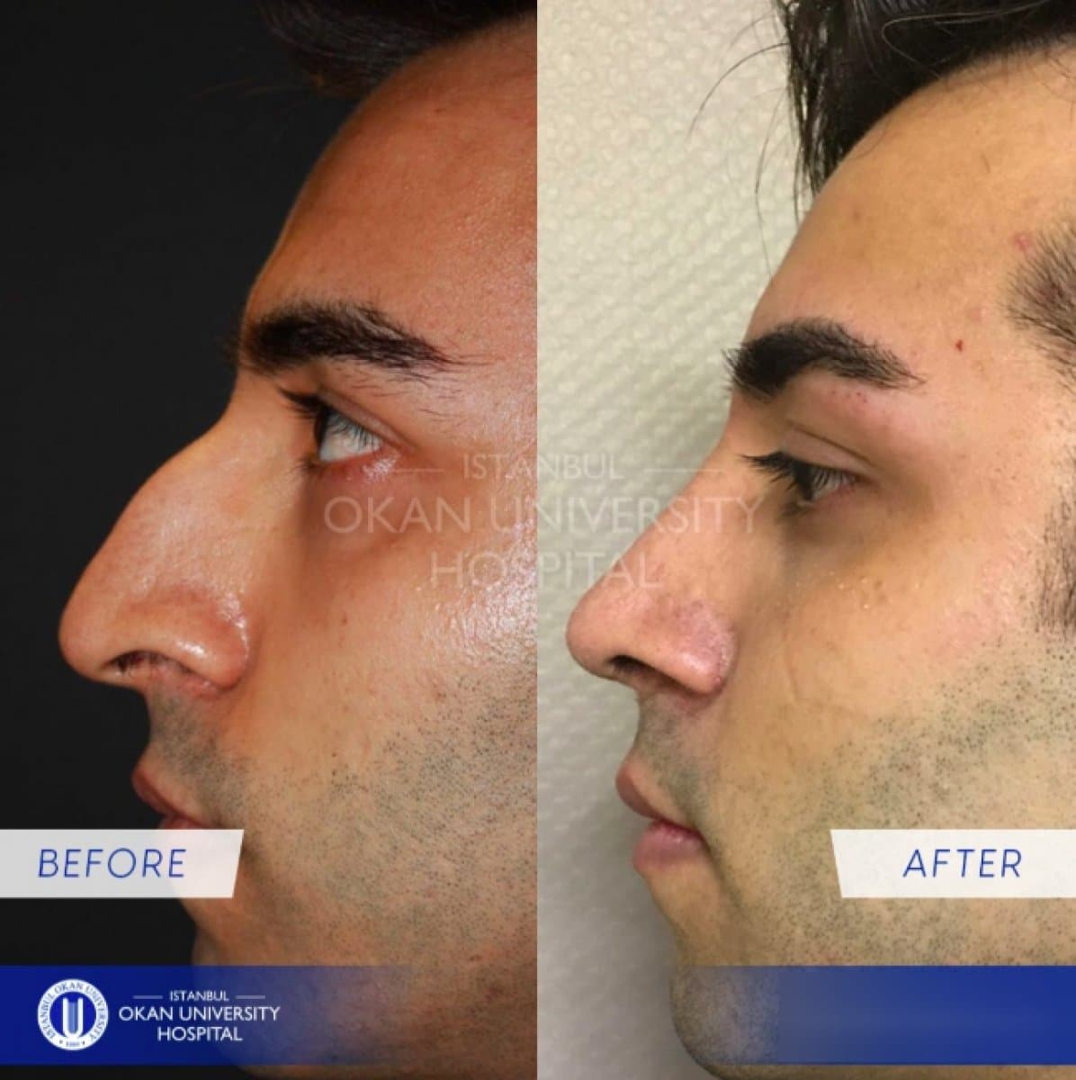 rhinoplasty