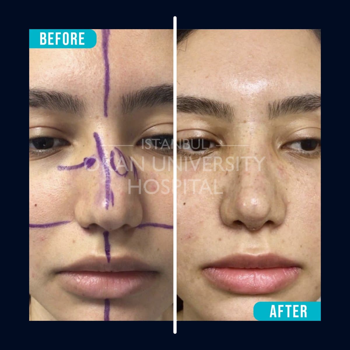 rhinoplasty