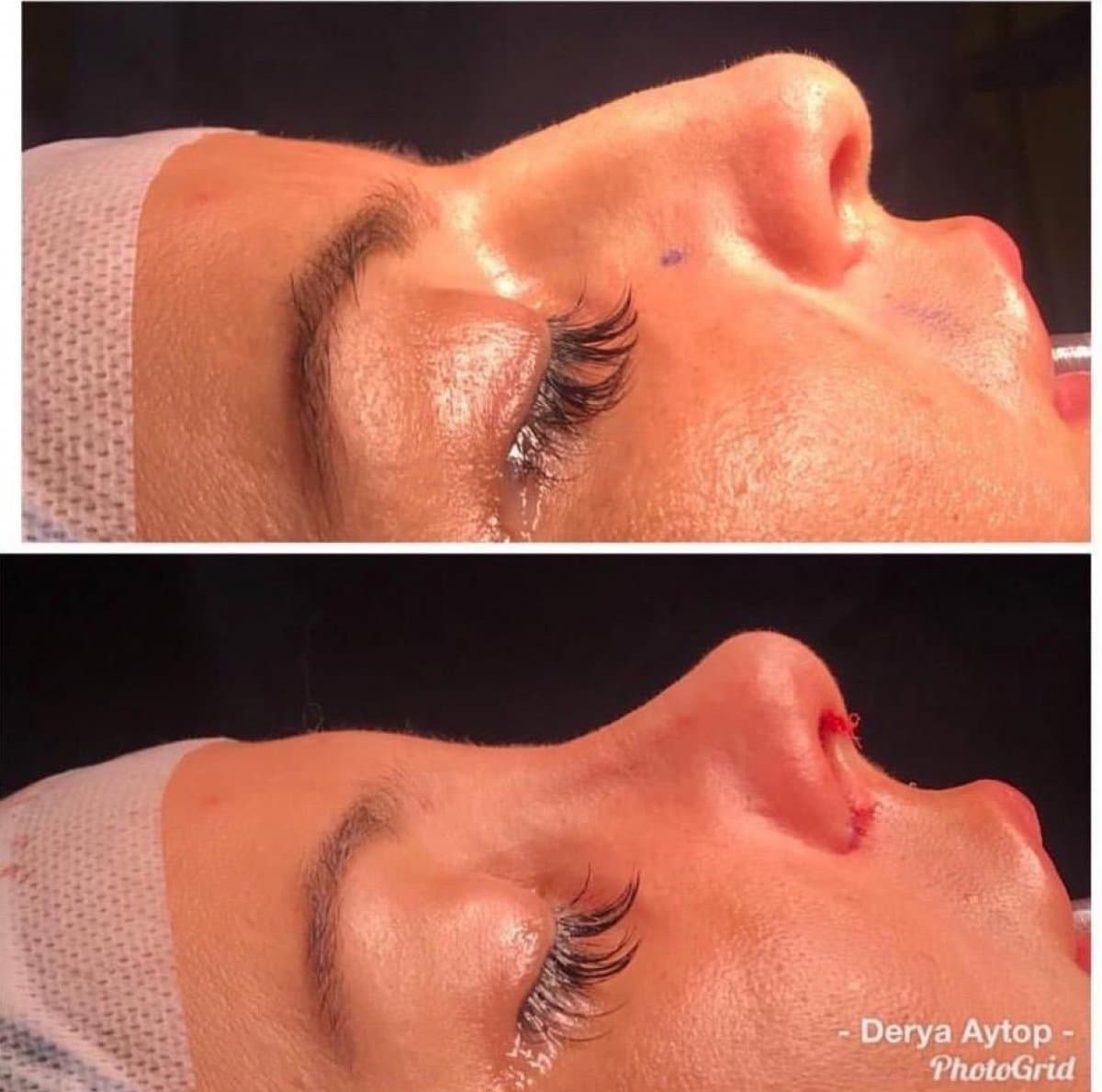 septoplasty