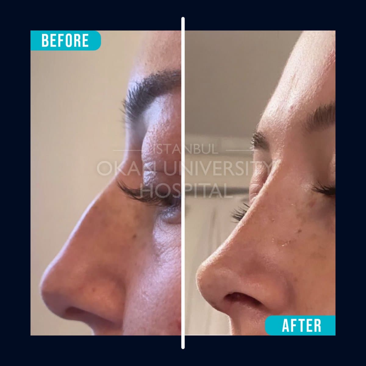 rhinoplasty