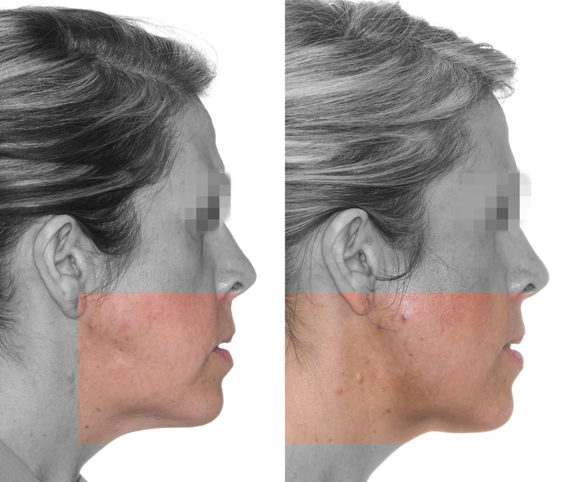 chin implant