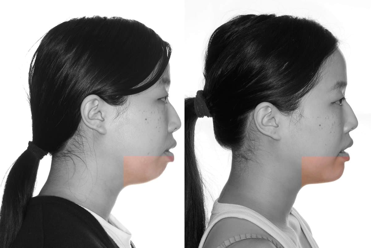 chin implant