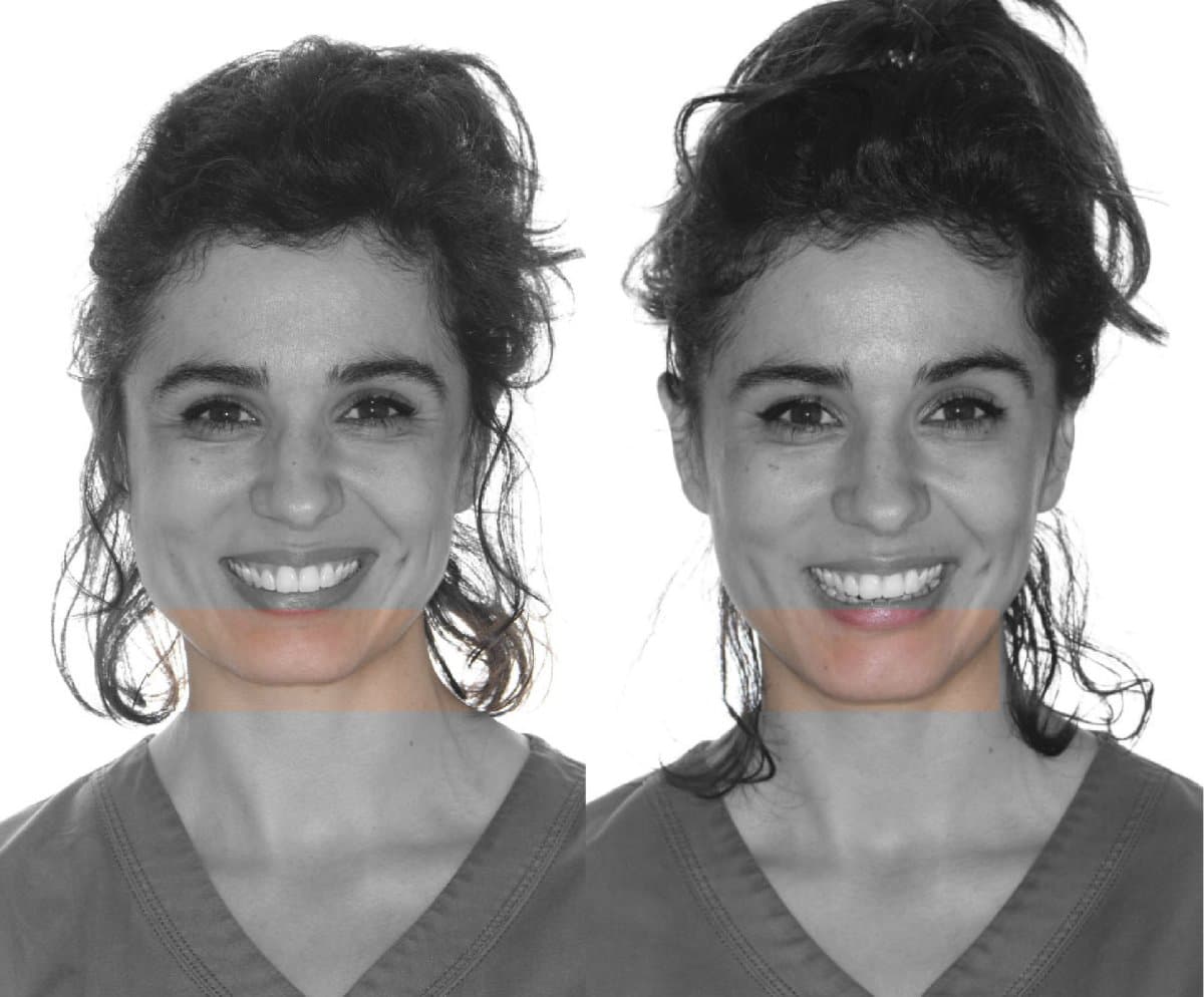 chin implant