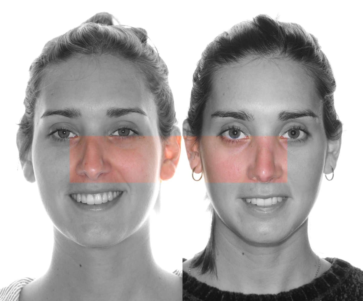rhinoplasty