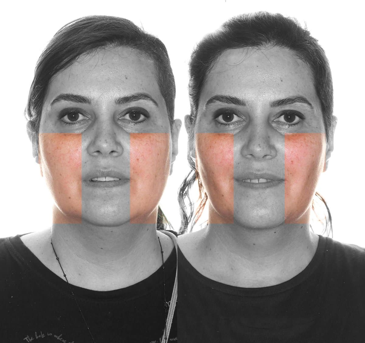 buccal fat extraction