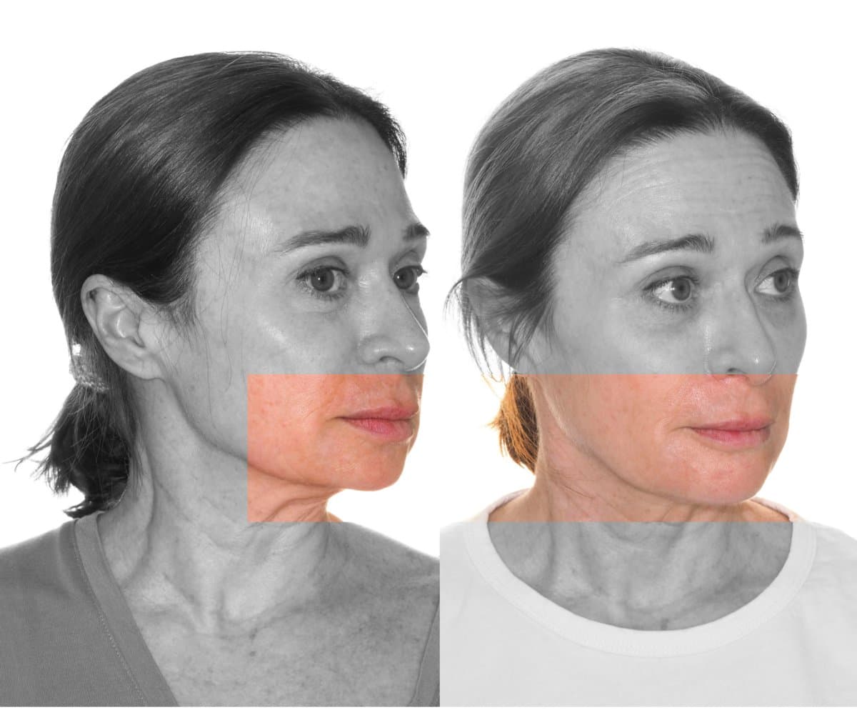 chin implant