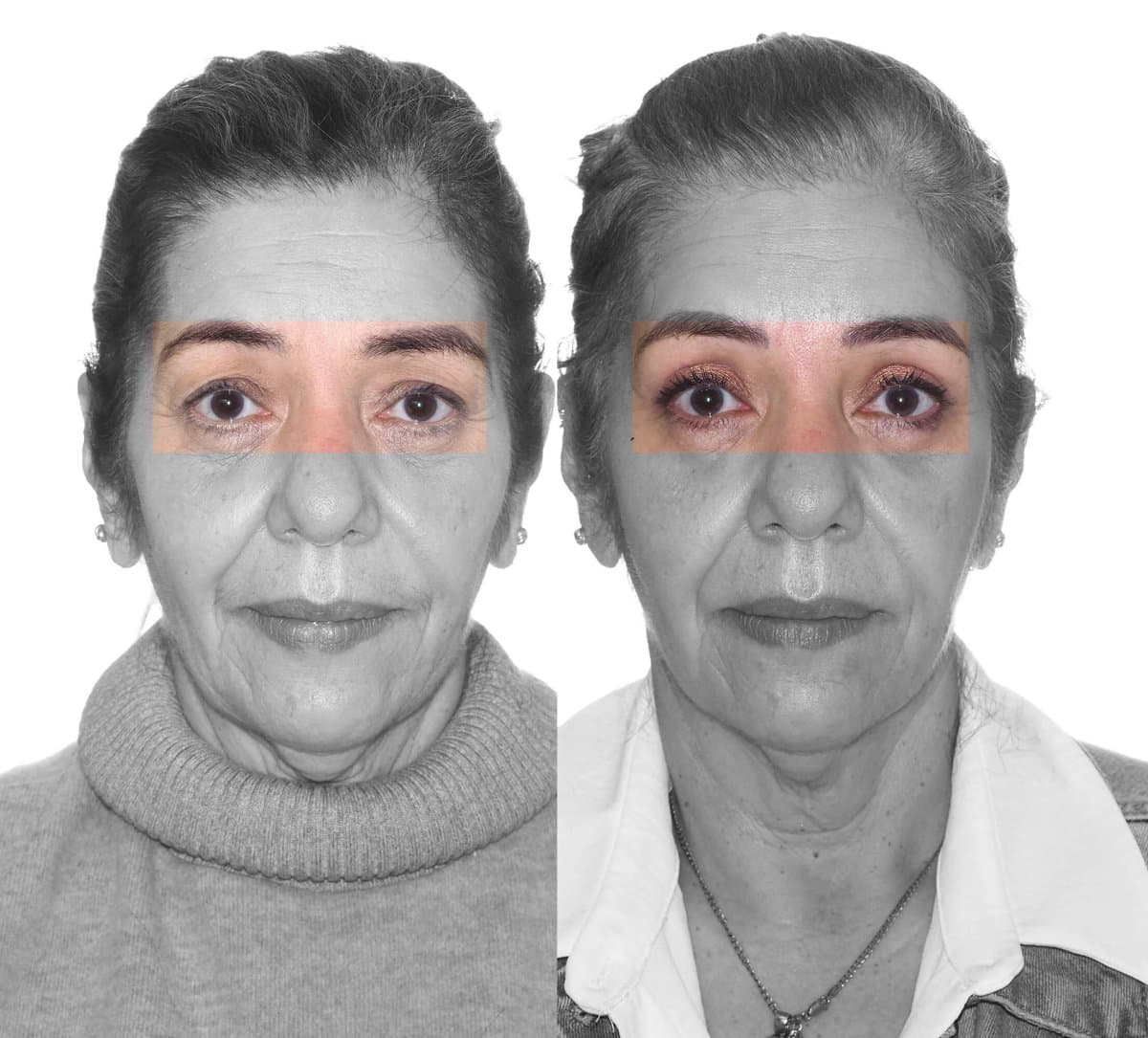 blepharoplasty