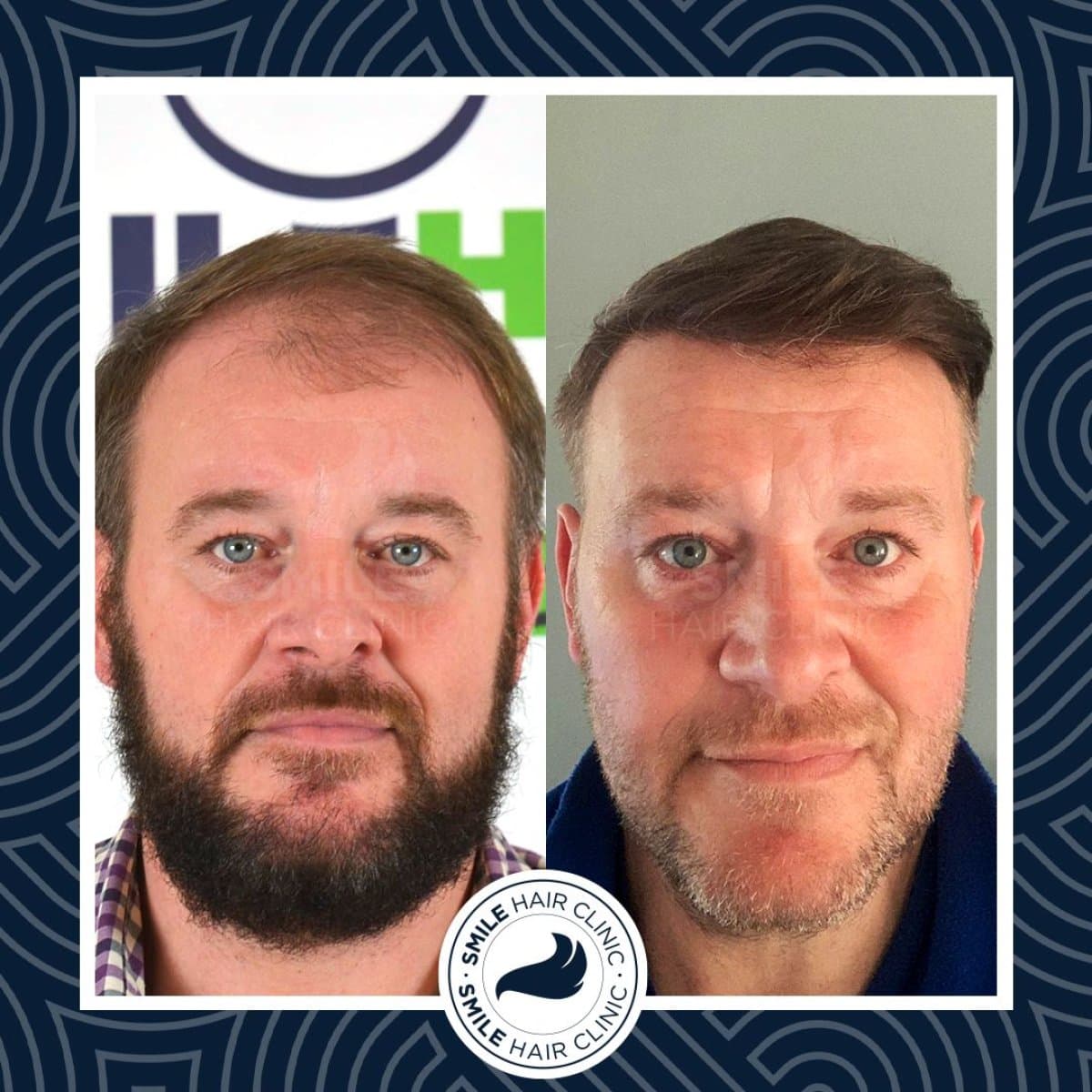 DHI hair transplant