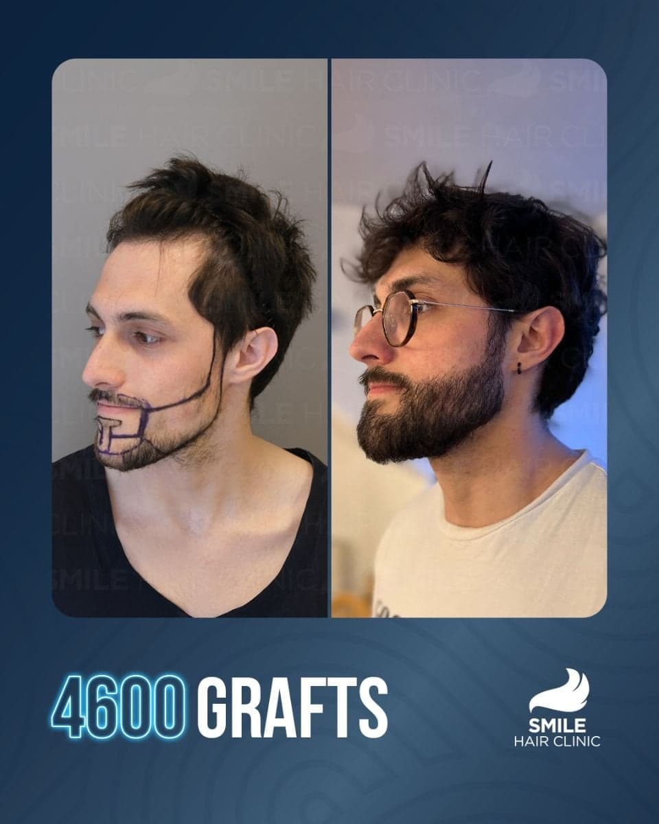 beard transplant