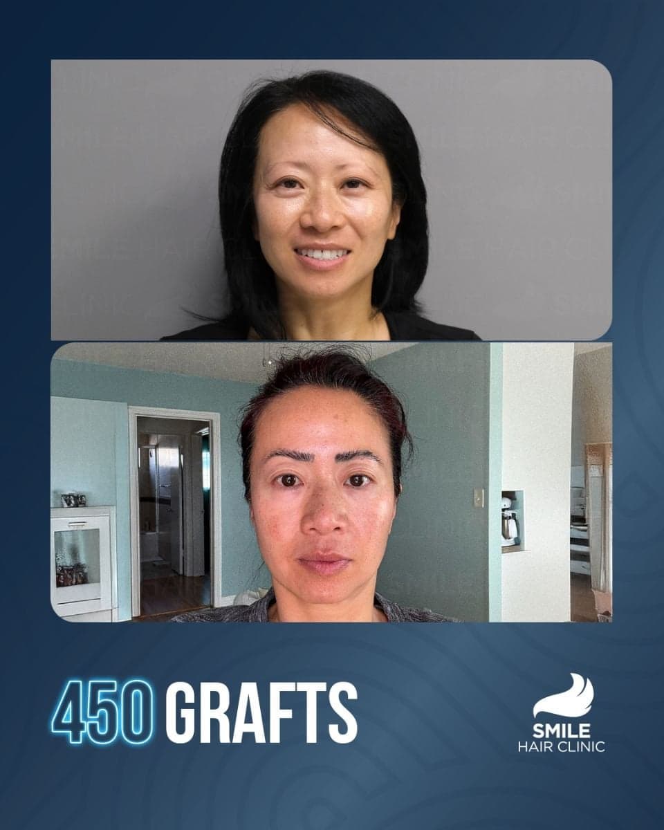 eyebrow transplant